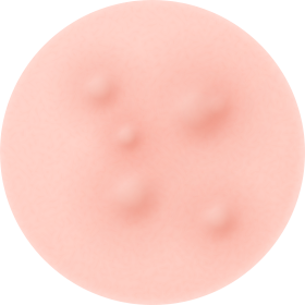 연포성 여드름 사진