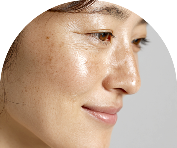기미·잡티·흑자 사진