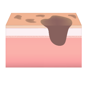 혼합형 색소 피부층 사진