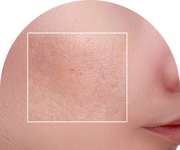 모공·흉터 사진