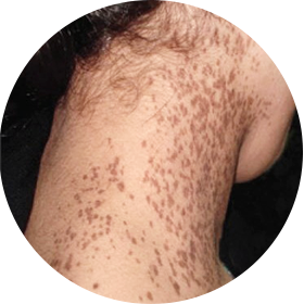 군집성 흑자증 사진