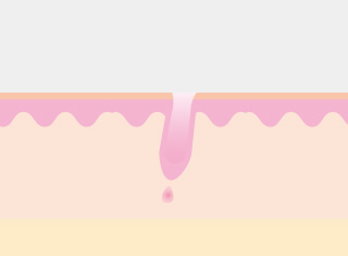 레이저제모 시술과정_3