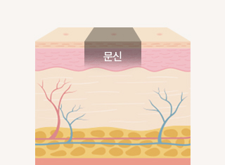 문신제거 시술과정_1