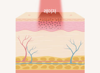 문신제거 시술과정_2