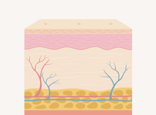 문신제거 시술과정_3