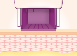 써마지FLX 시술과정_1