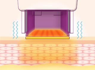 써마지FLX 시술과정_3